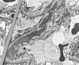 M,19y. | membranous glomerulopathy - lupus erythematodes st. IV M,19y. | membranous glomerulopathy - lupus erythematodes st. IV